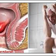 Illustration for article titled obat wasir alami